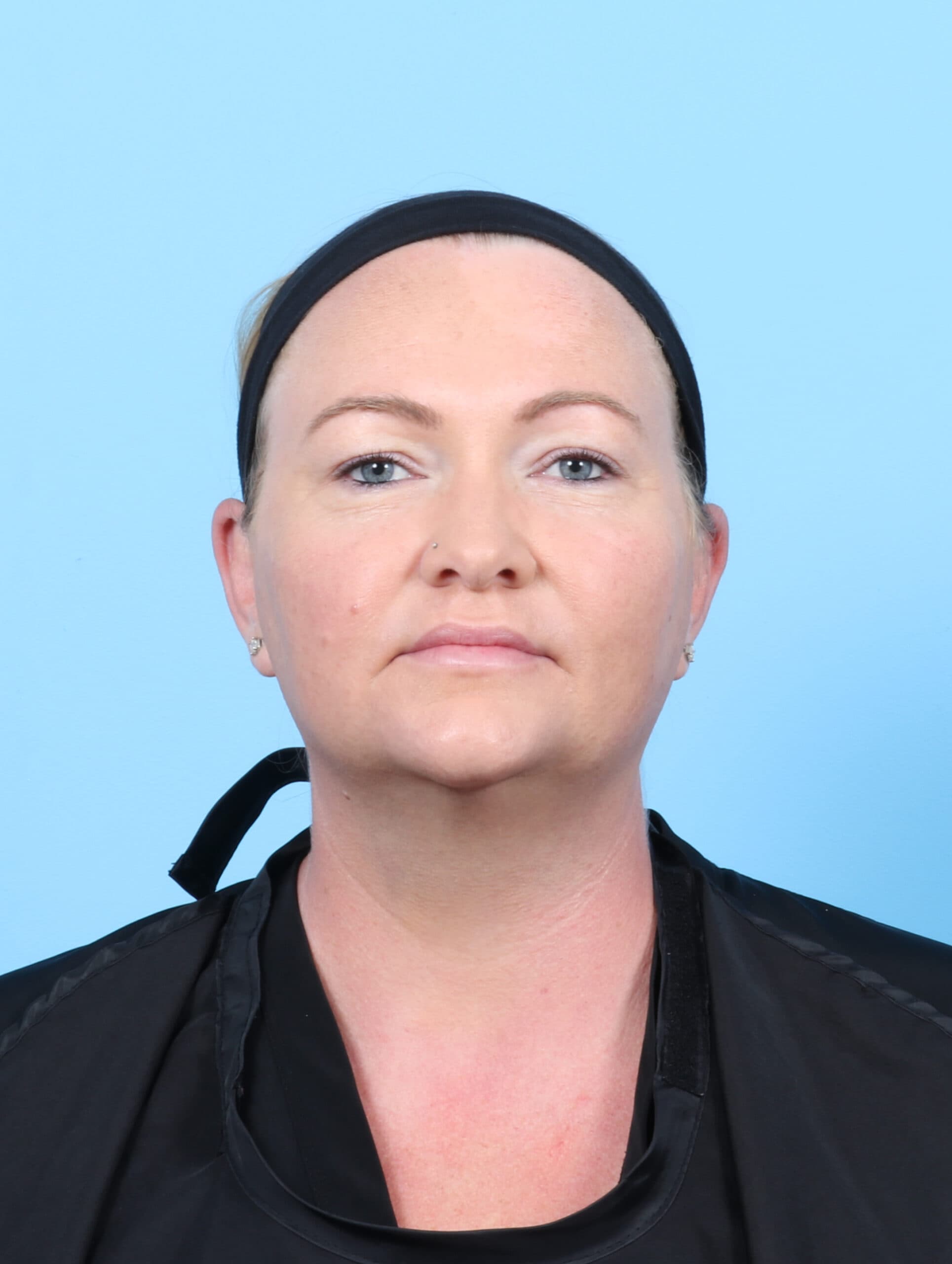 Facial Liposuction case #6998 after