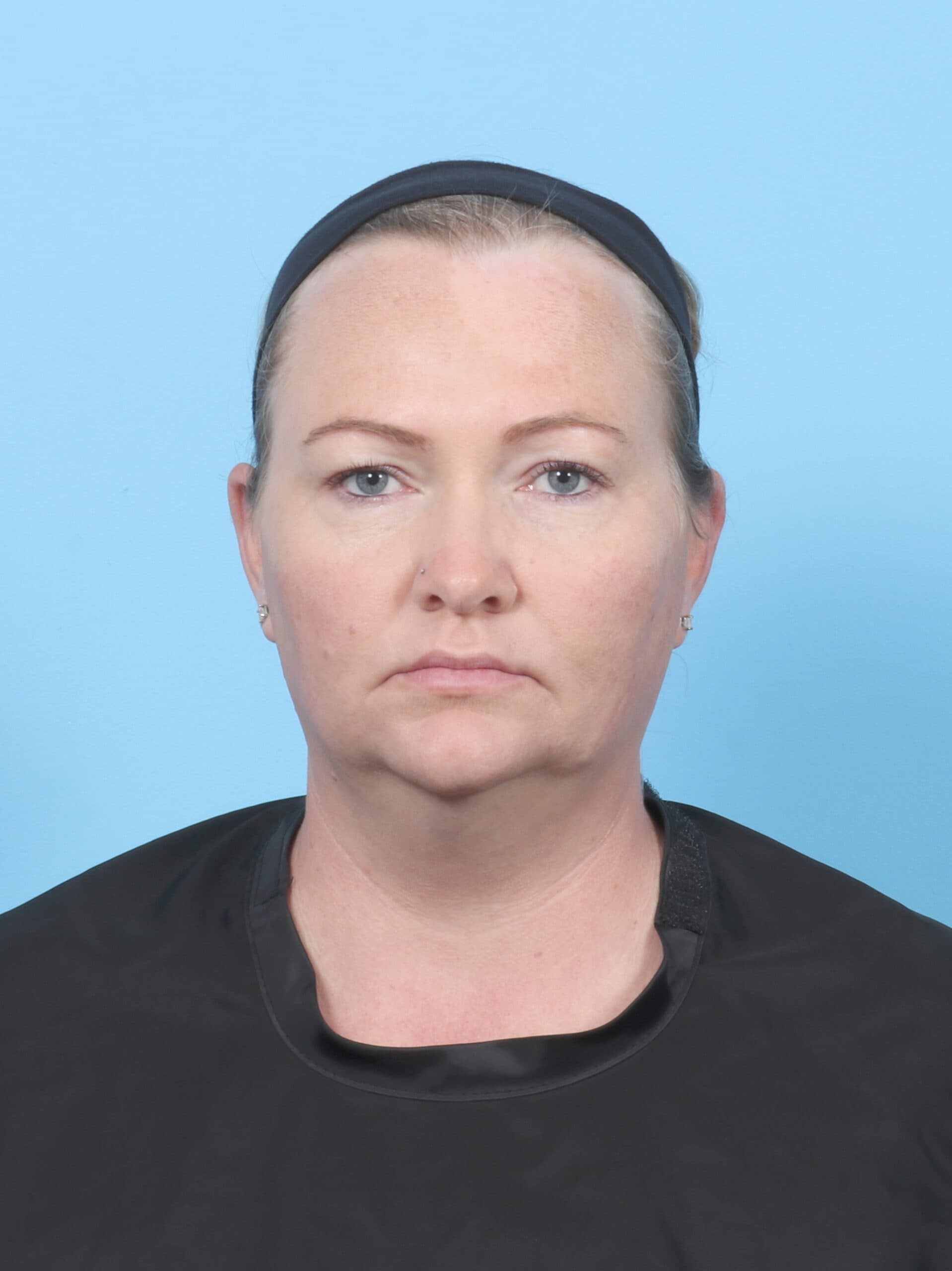 Facial Liposuction case #6998 before