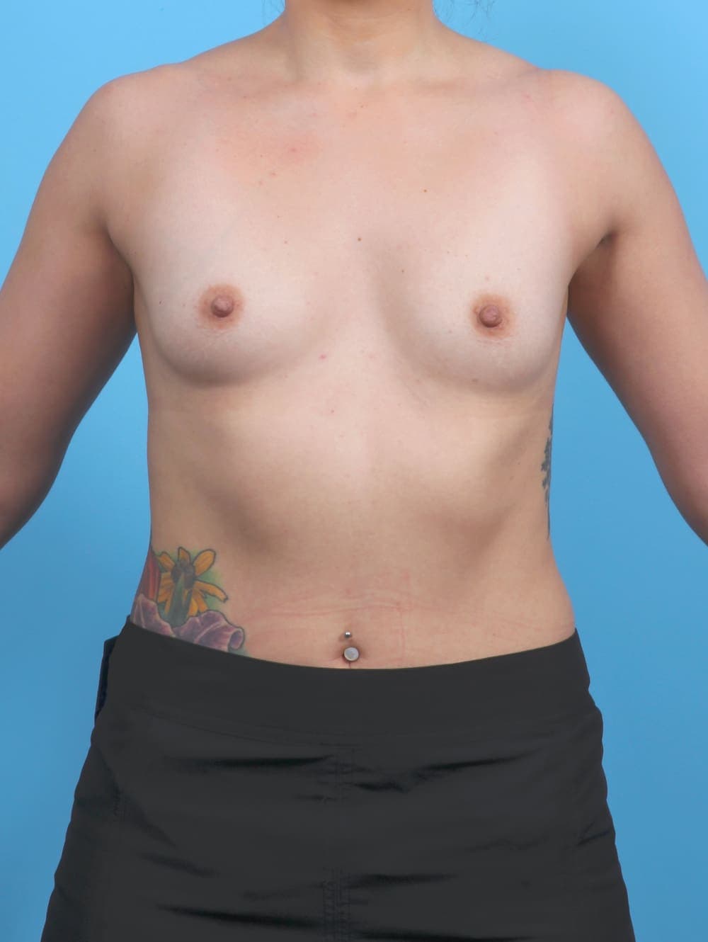 Breast Augmentation case #6010 before, image 1