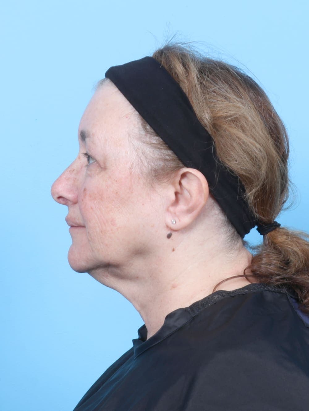 Eyelid Surgery case #6751 after, image 3