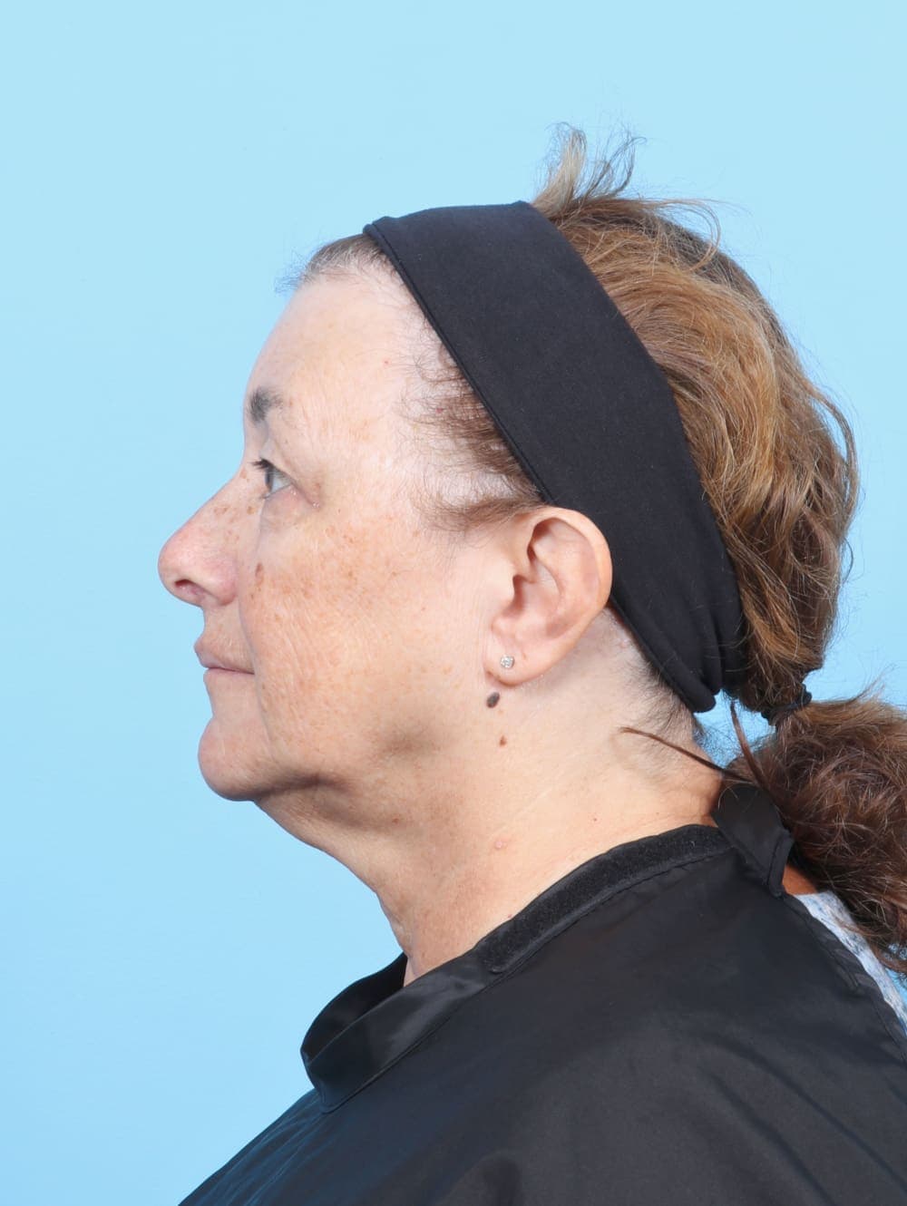 Eyelid Surgery case #6751 before, image 3