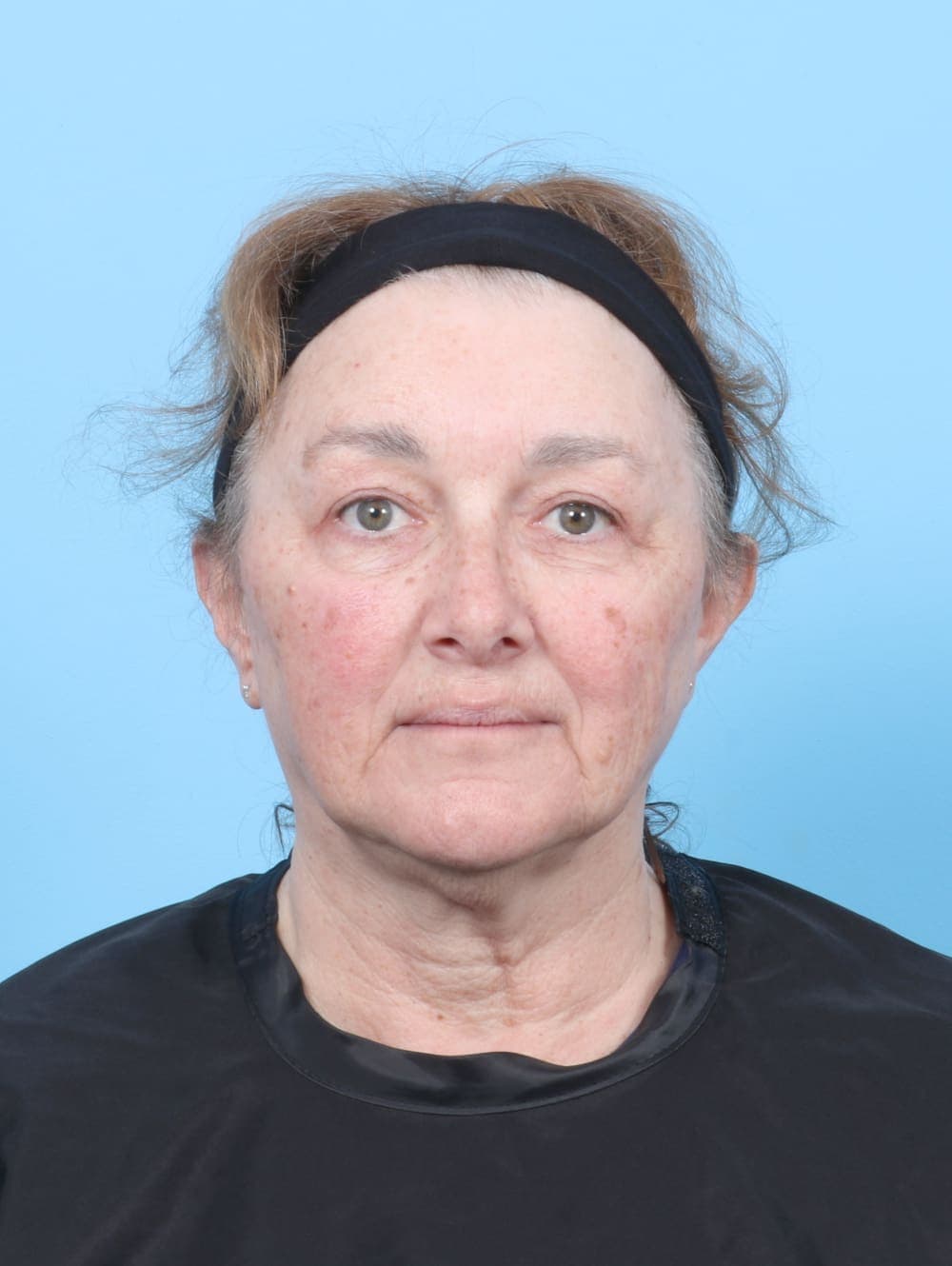 Eyelid Surgery case #6751 after