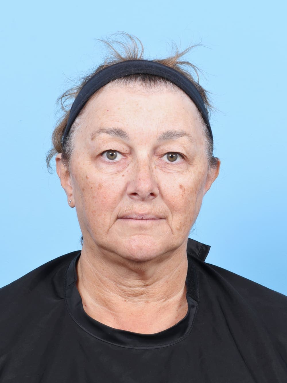 Eyelid Surgery case #6751 before