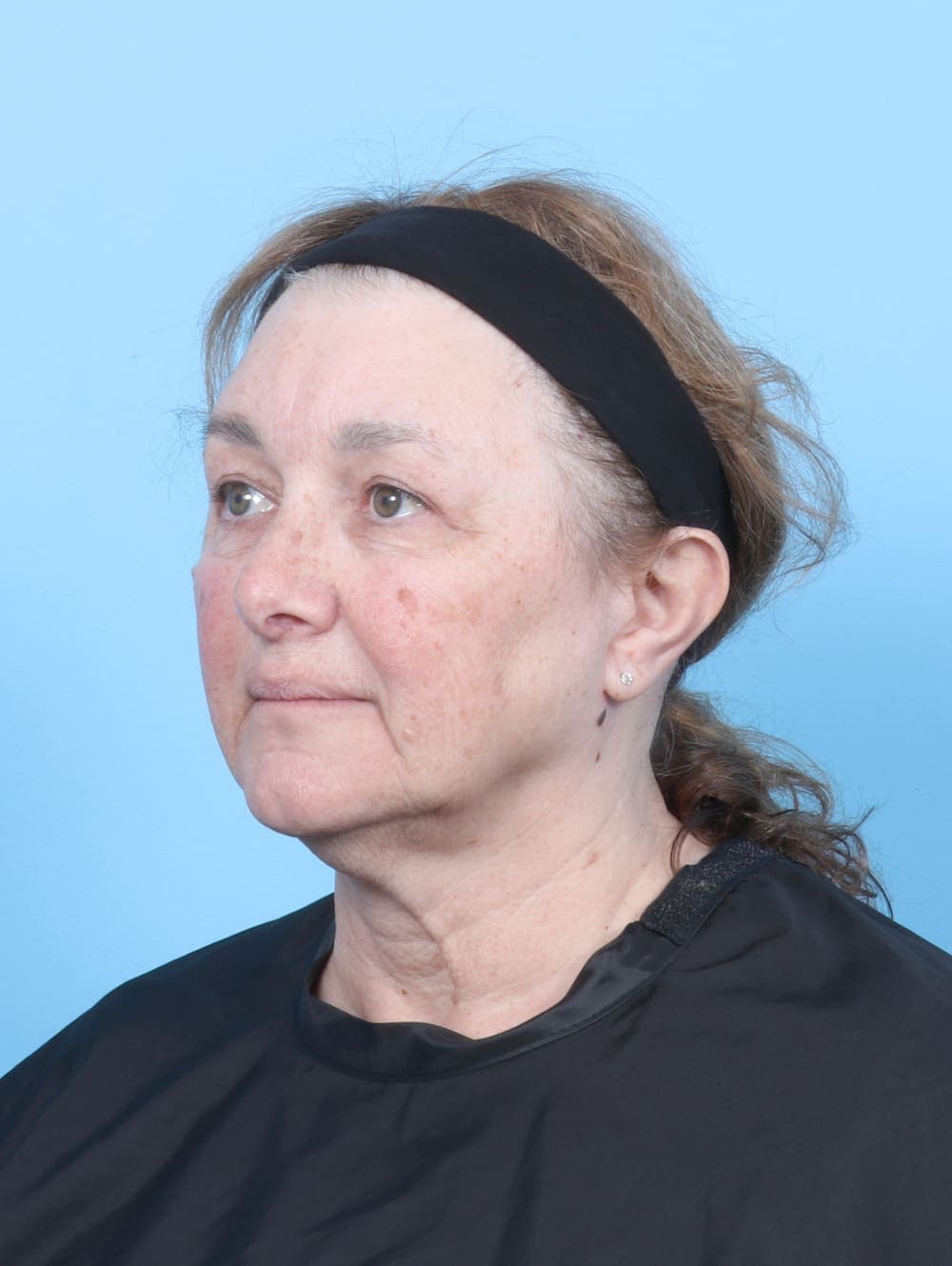 Eyelid Surgery case #6751 after, image 2