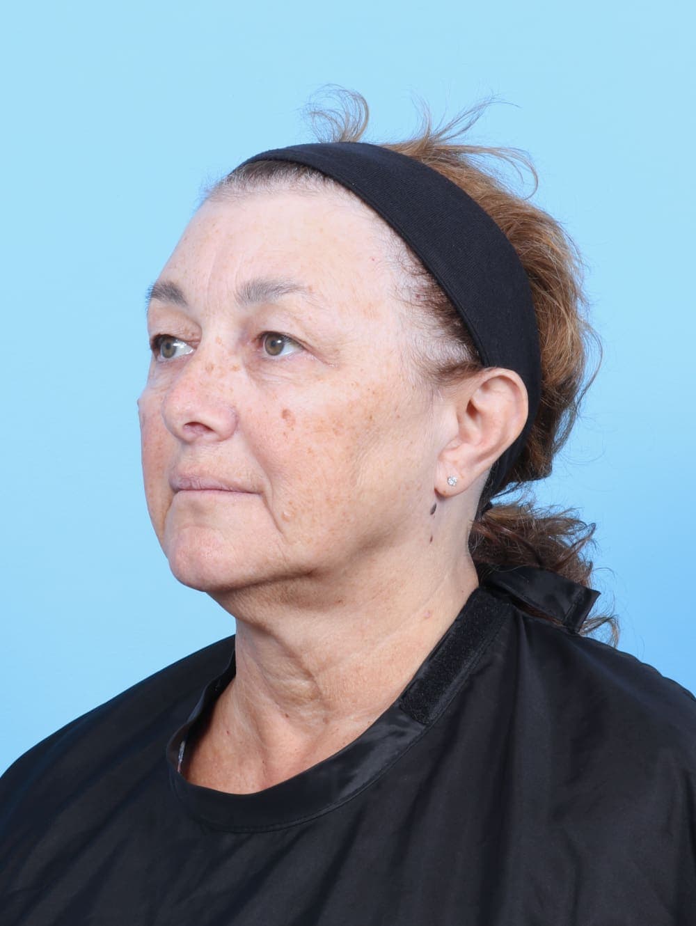 Eyelid Surgery case #6751 before, image 2