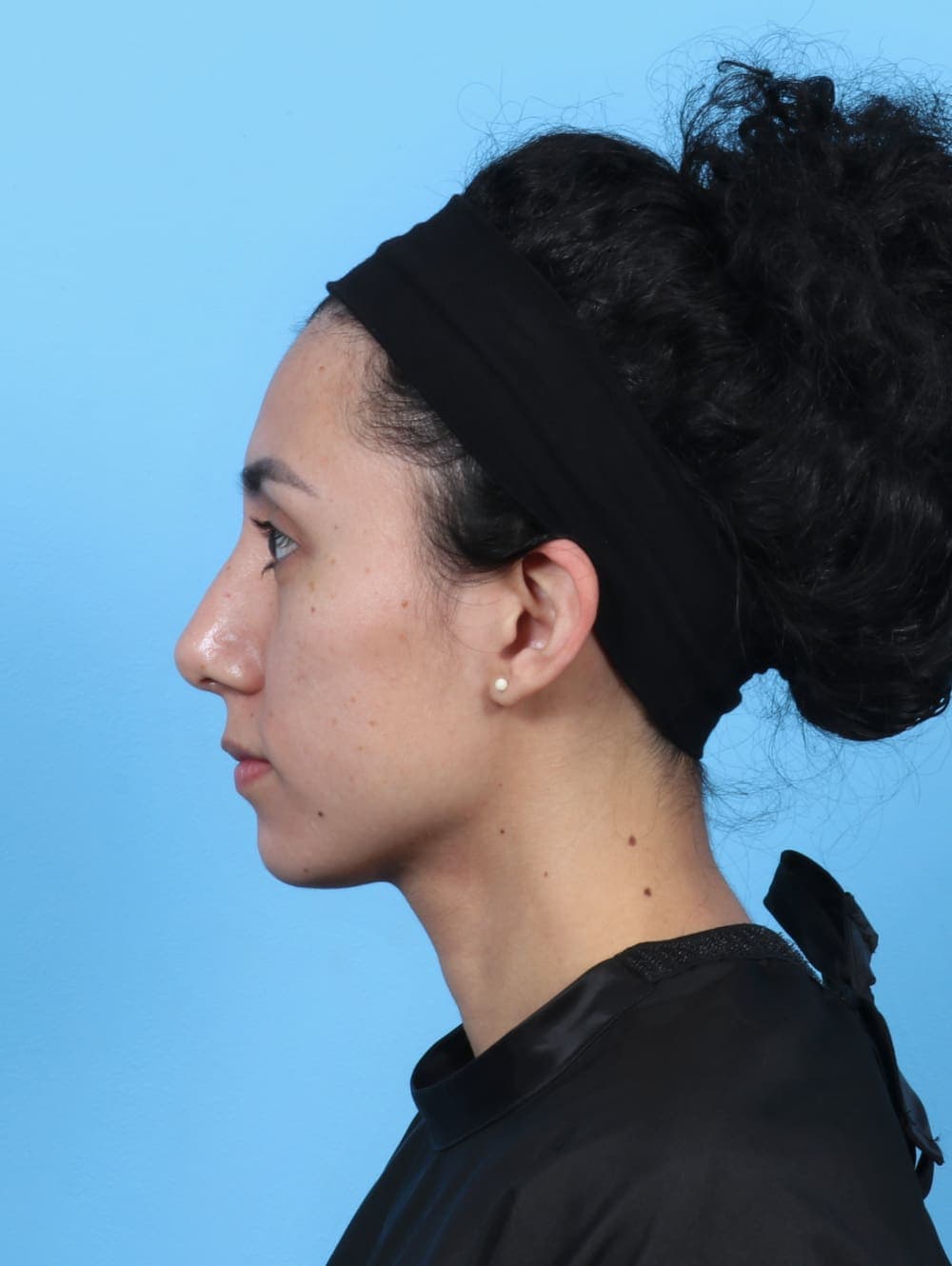 Rhinoplasty case #6237 after
