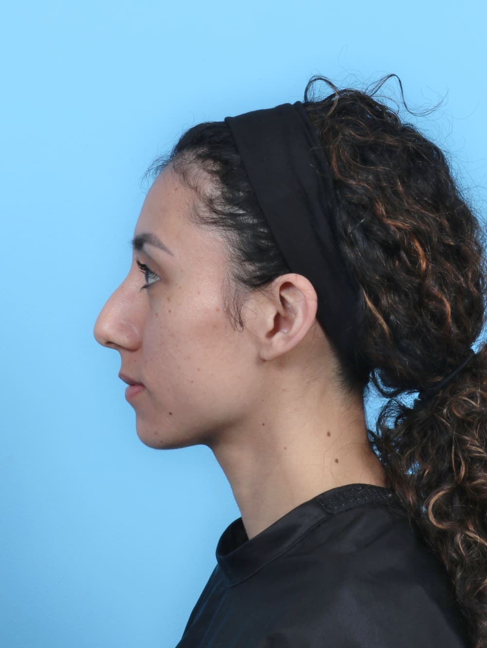 Rhinoplasty case #6237 before