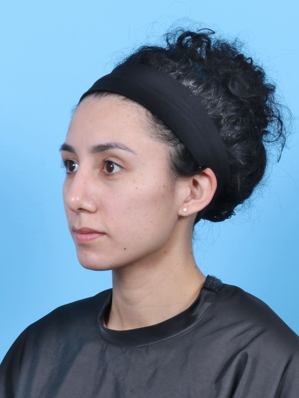 Rhinoplasty case #6237 after, image 3