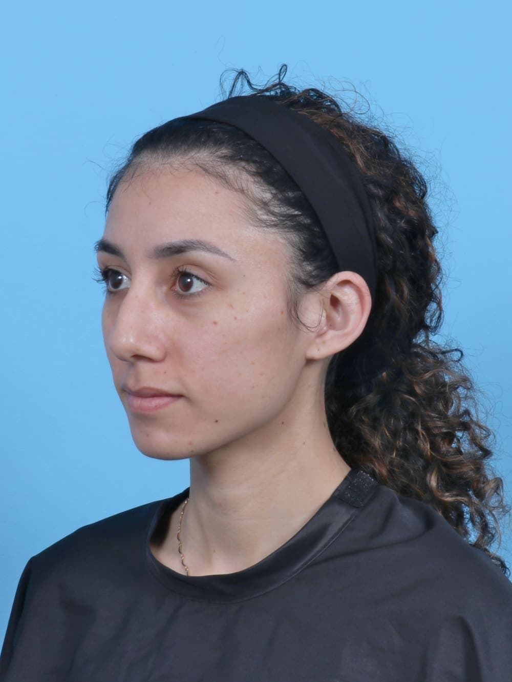 Rhinoplasty case #6237 before, image 3