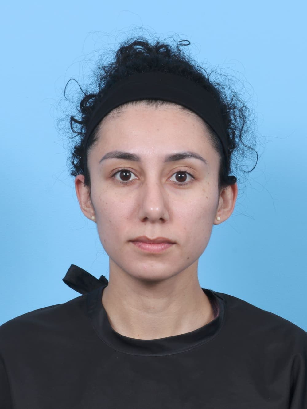 Rhinoplasty case #6237 after, image 2