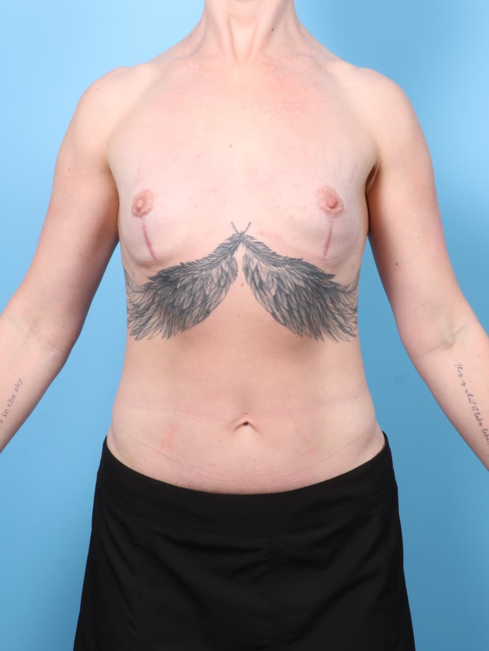 Breast Implant Removal with Lift case #7815 after, image 1
