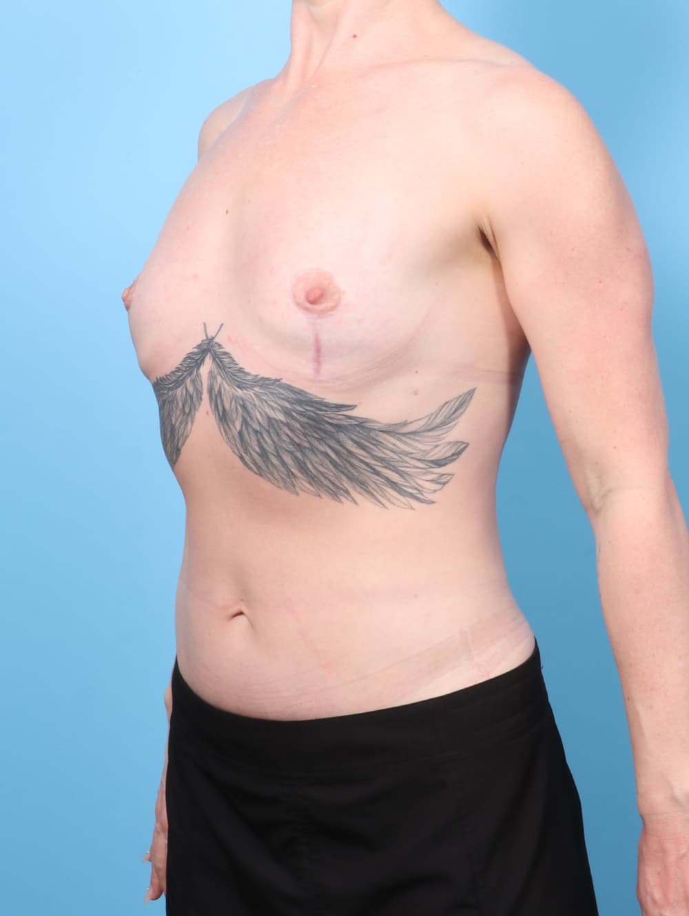 Breast Implant Removal with Lift case #7815 after, image 2