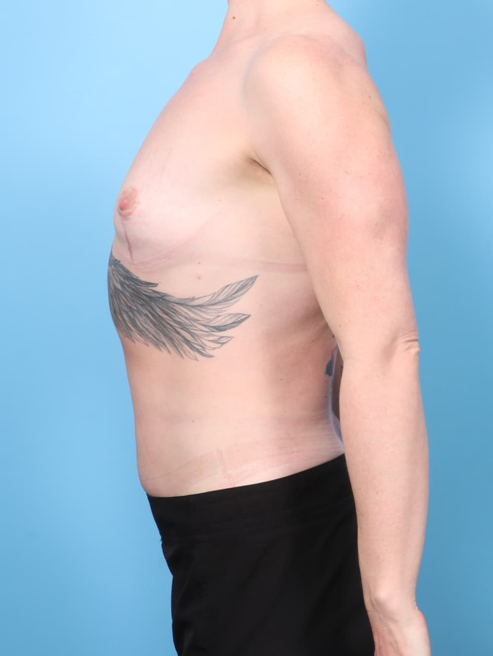 Breast Implant Removal with Lift case #7815 after, image 3