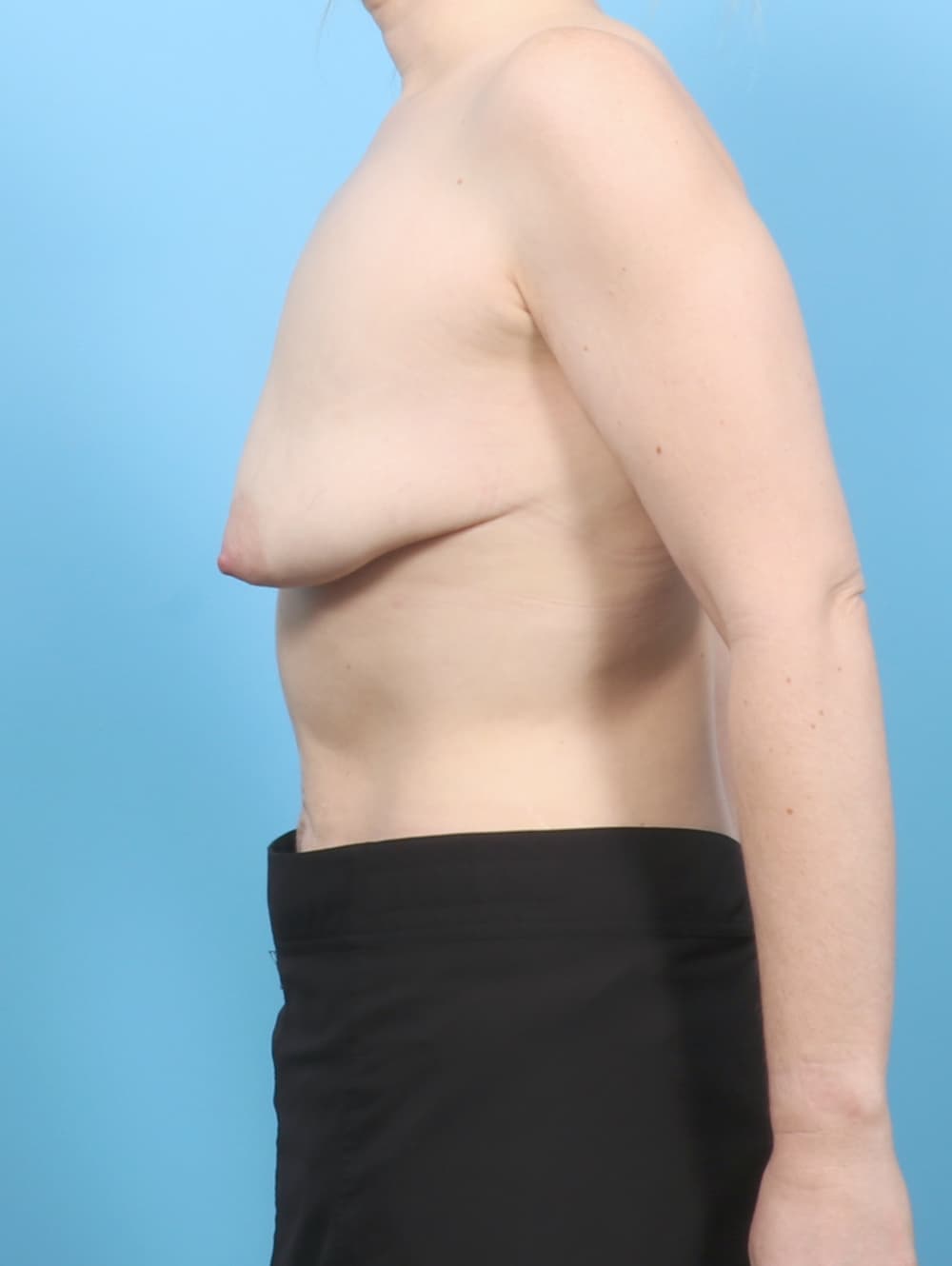 Breast Lift with Implants case #7519 before, image 3