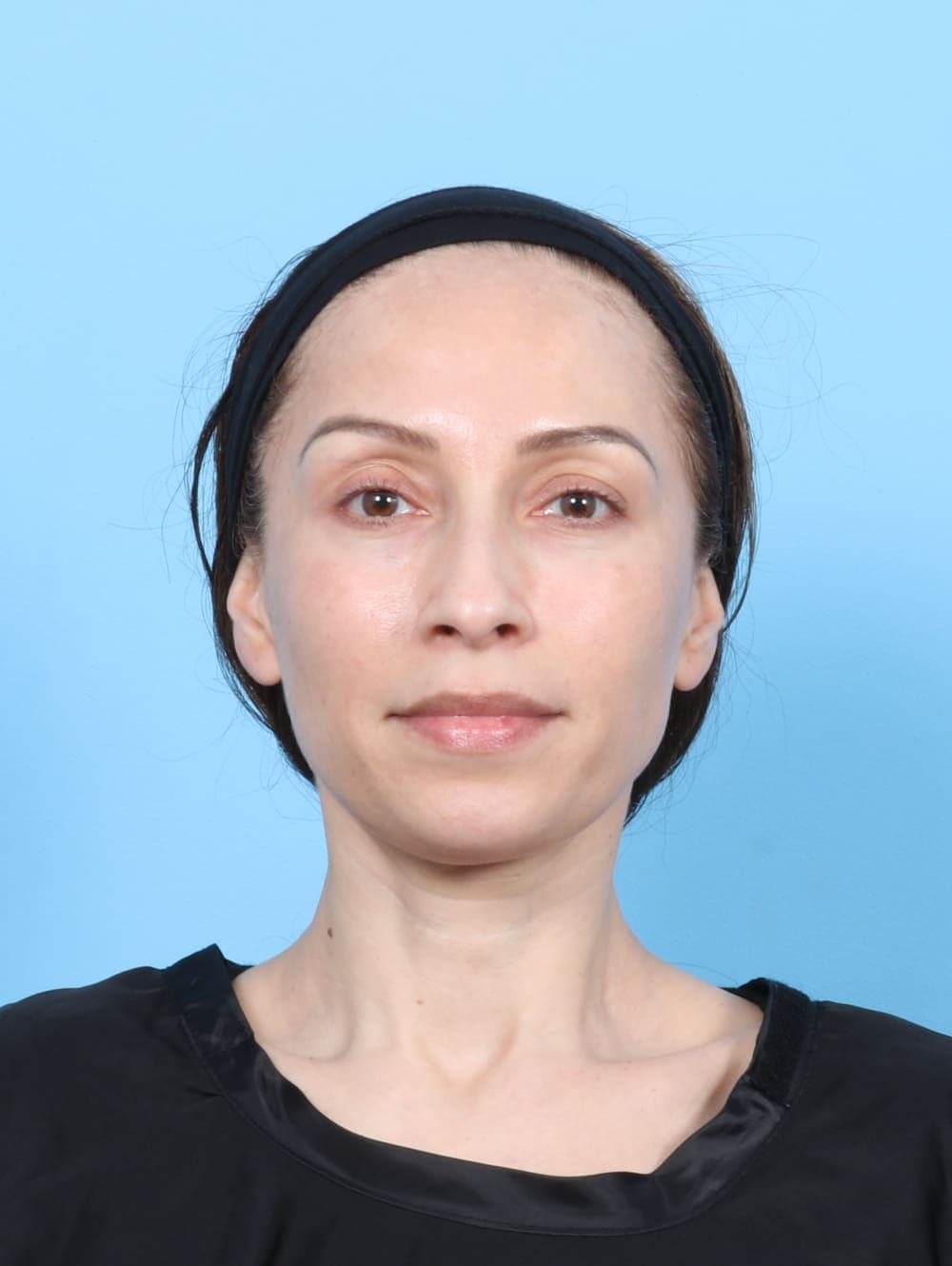 Eyelid Surgery case #6685 after, image 1