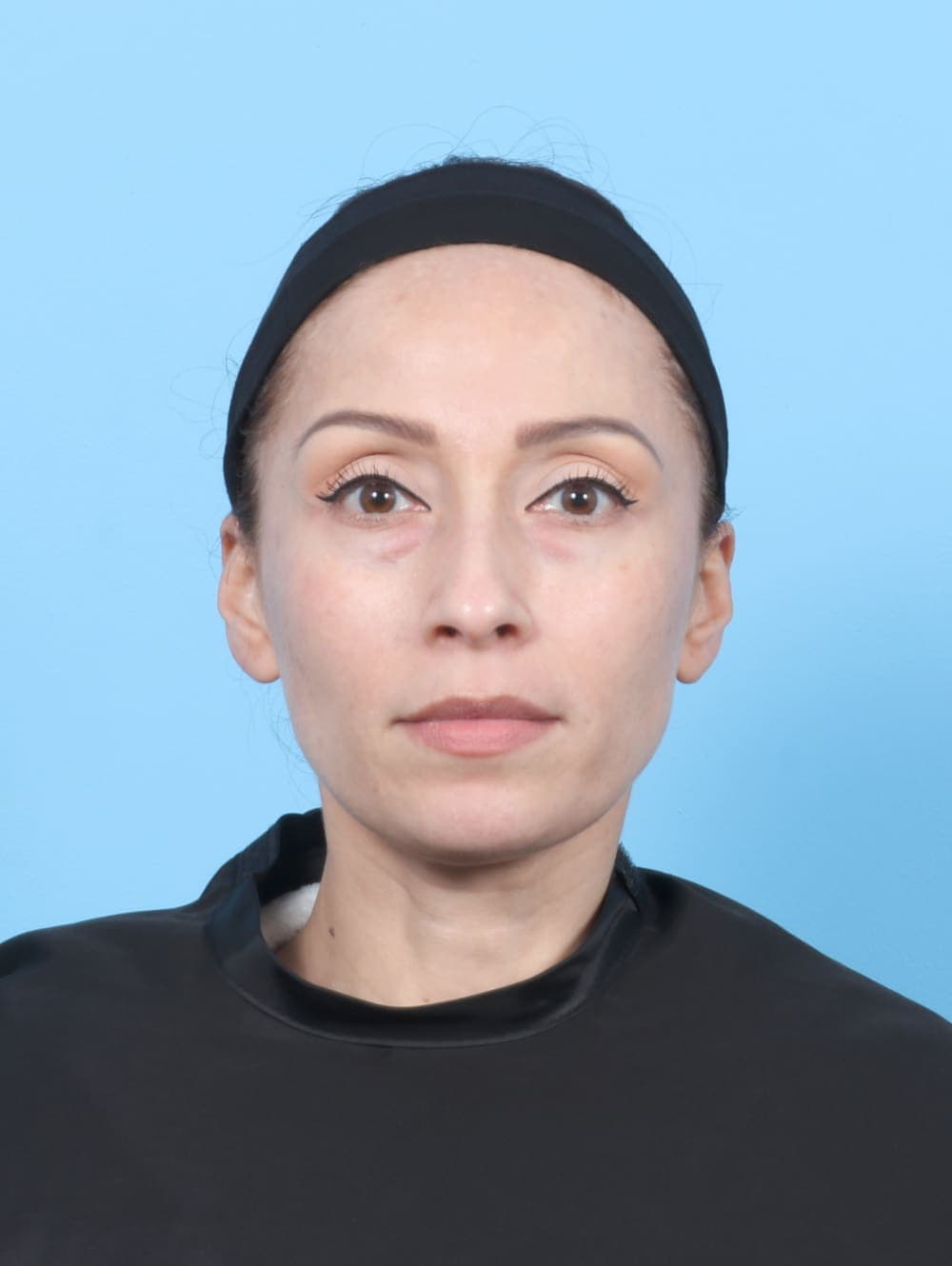 Eyelid Surgery case #6685 before, image 1