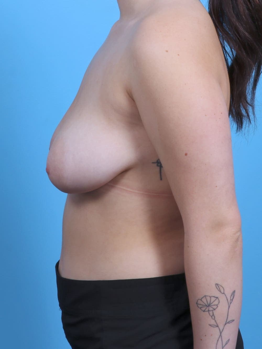 Breast Lift/Reduction case #4499 before, image 3