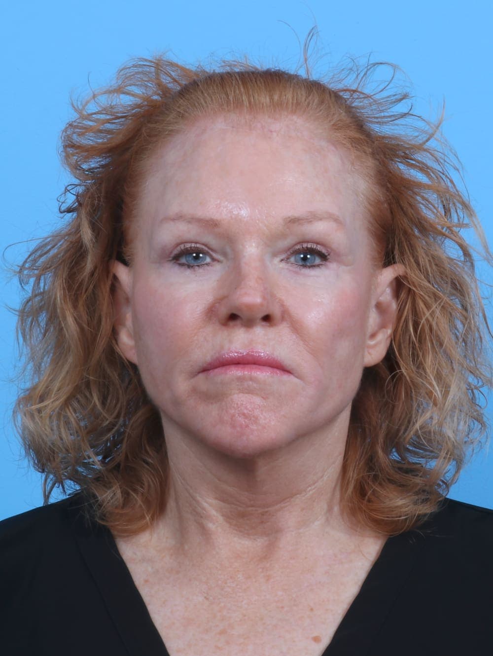 Brow Lift case #3925 after, image 1
