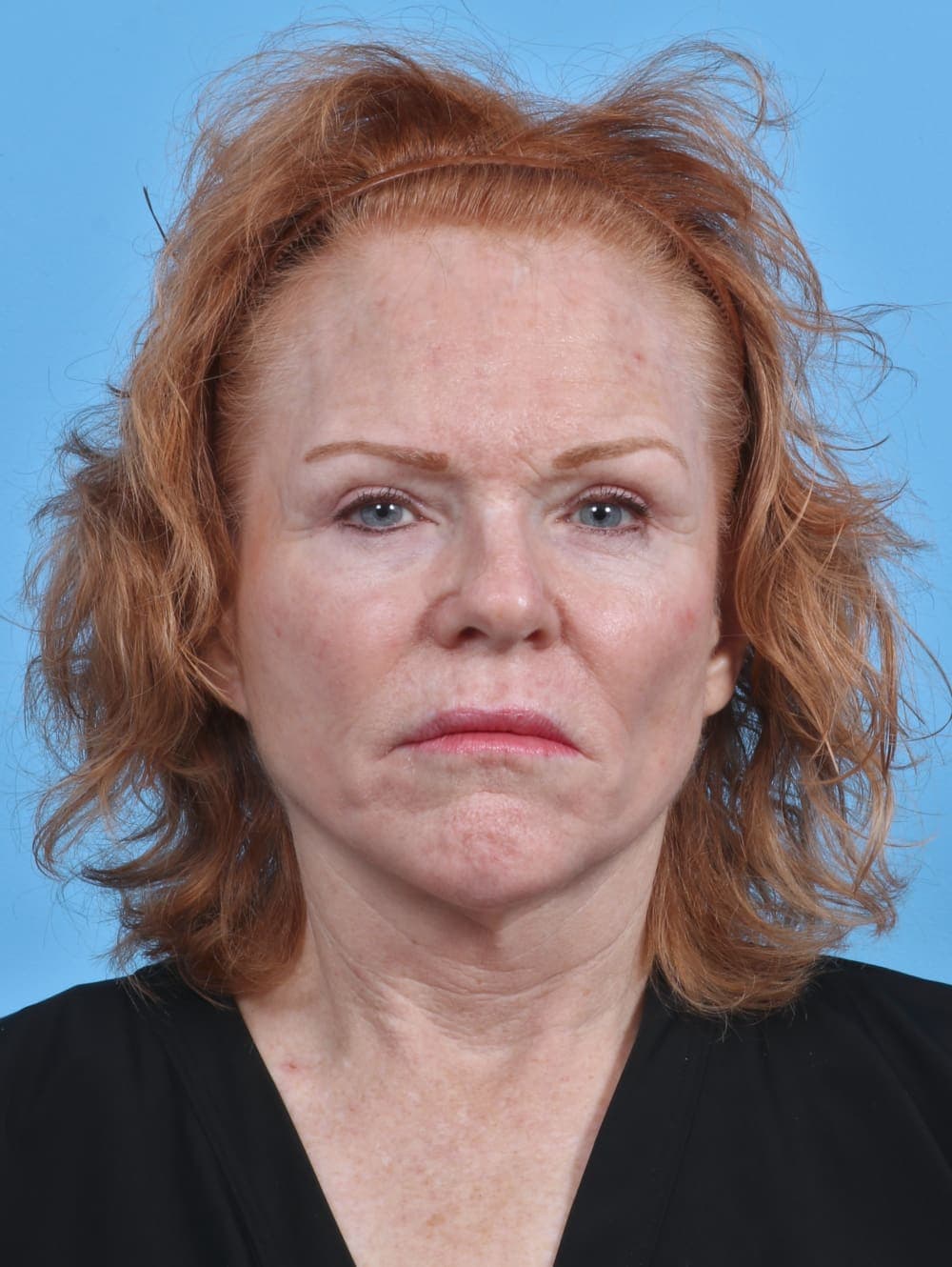 Brow Lift case #3925 before, image 1