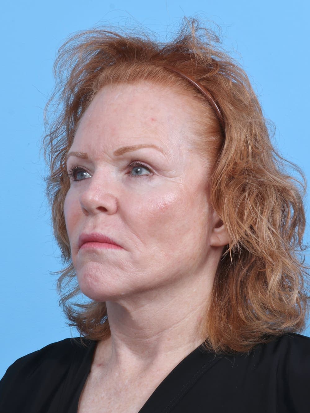 Brow Lift case #3925 before, image 2