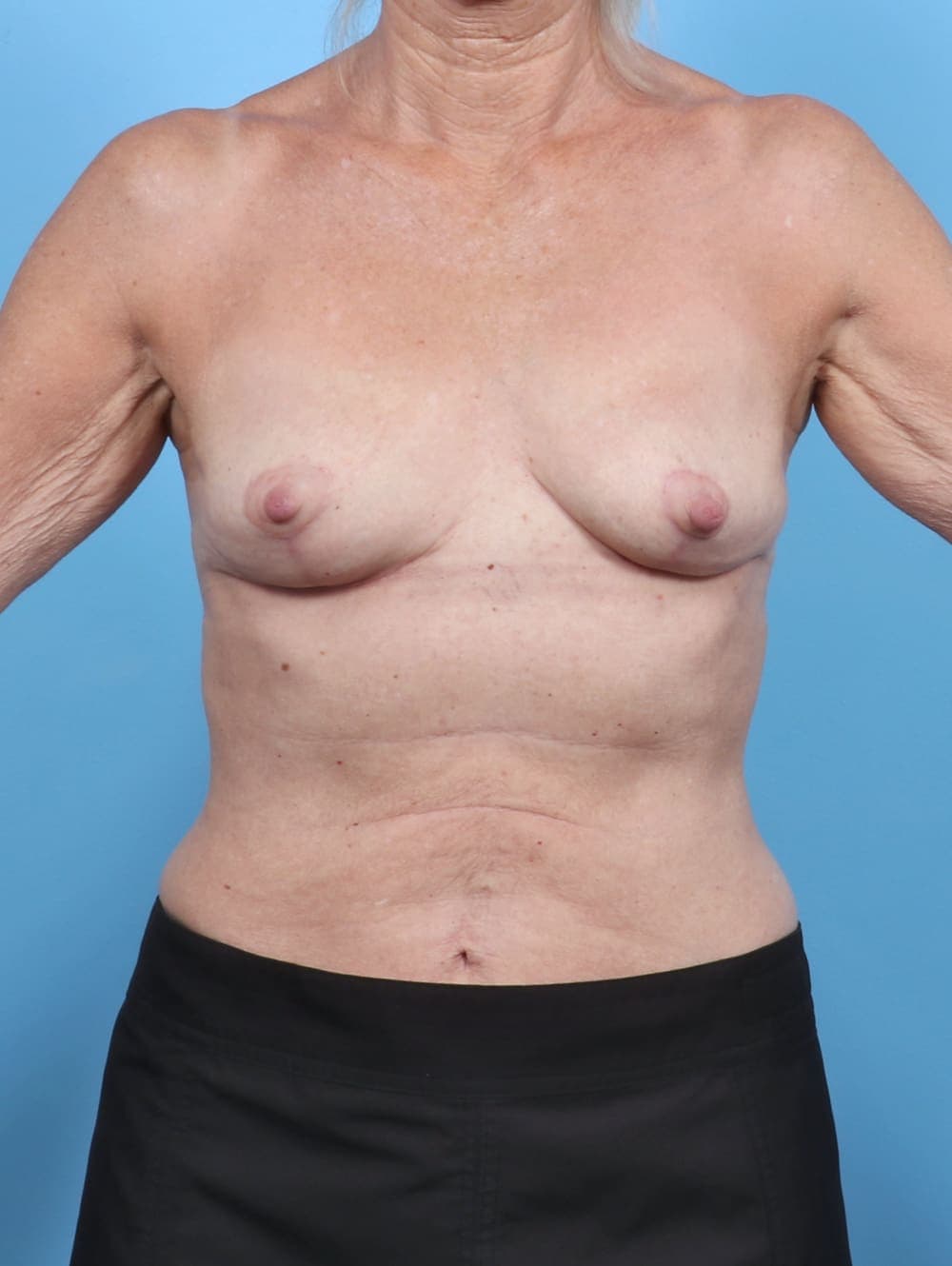 Breast Implant Removal with Lift case #5367 after