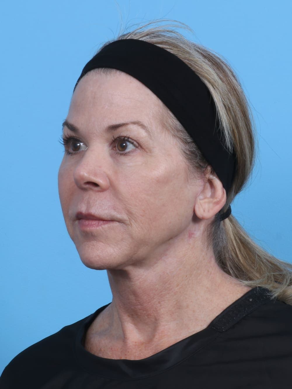 Facelift case #4211 after, image 2