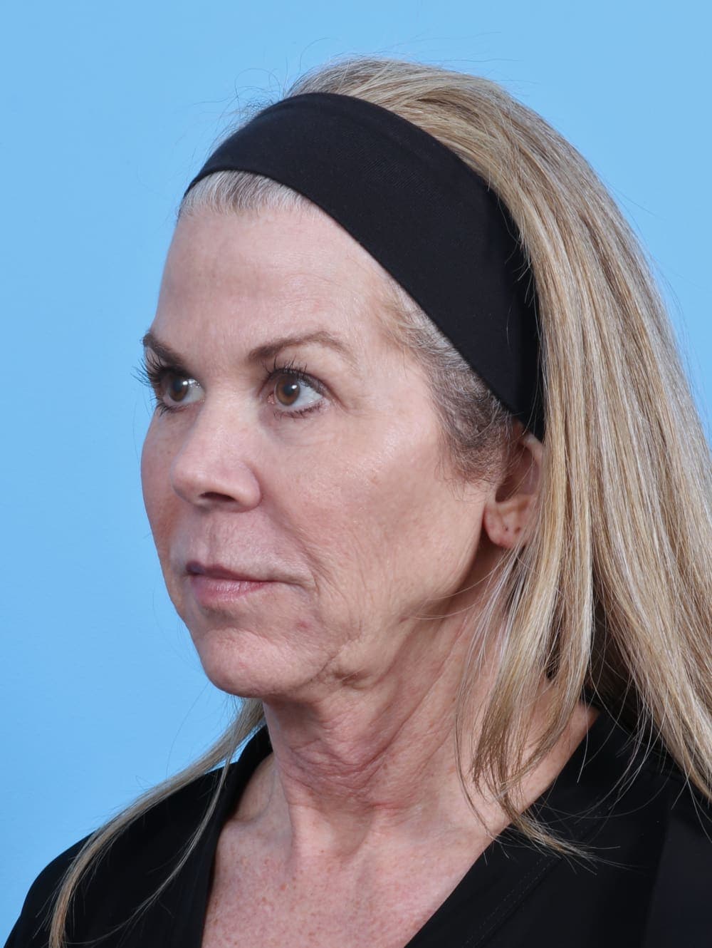 Facelift case #4211 before, image 2