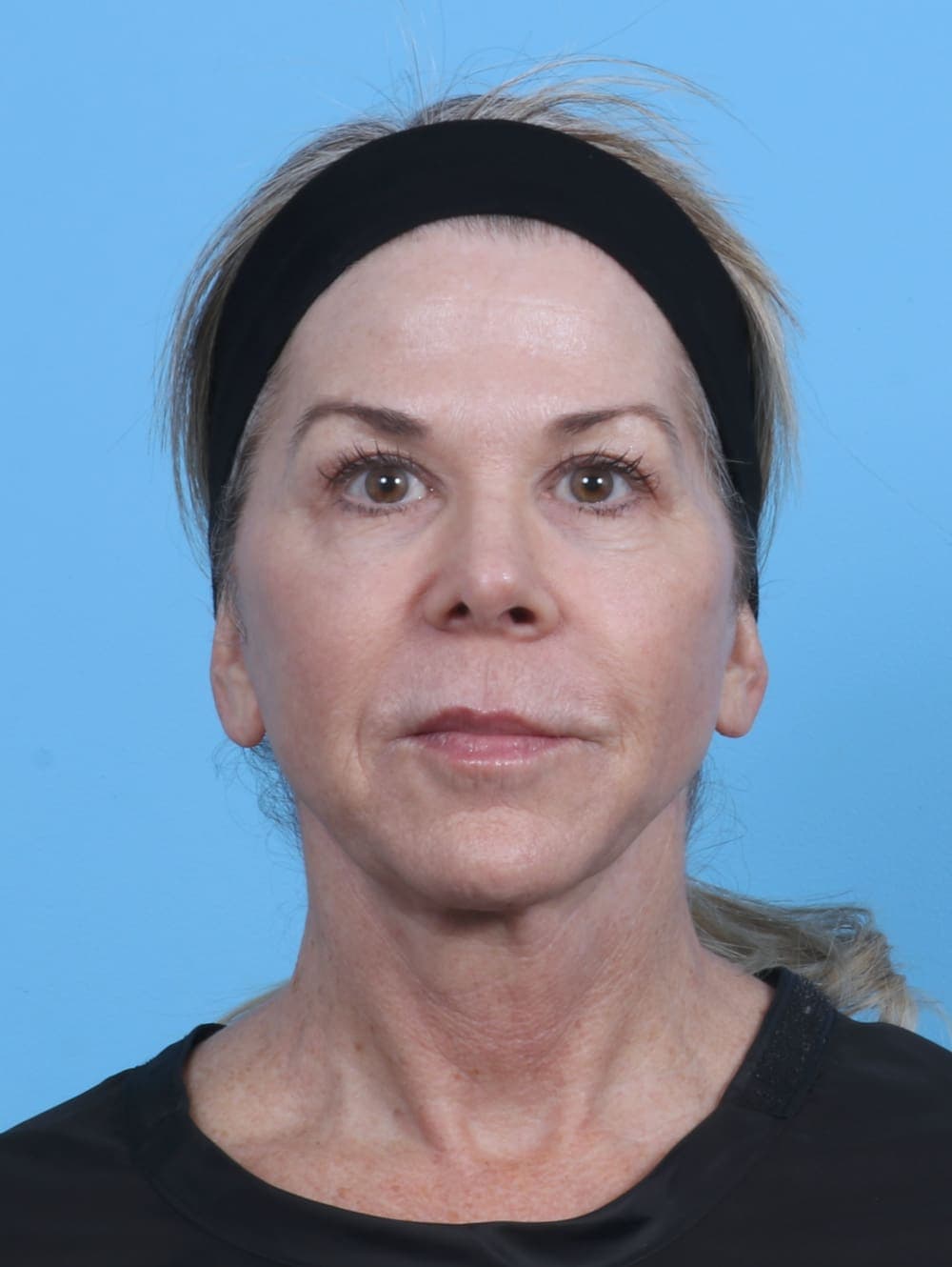 Facelift case #4211 after