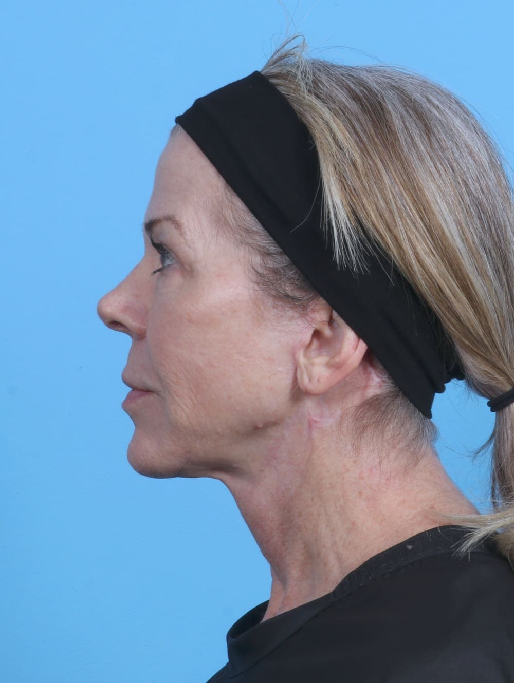 Facelift case #4211 after, image 3