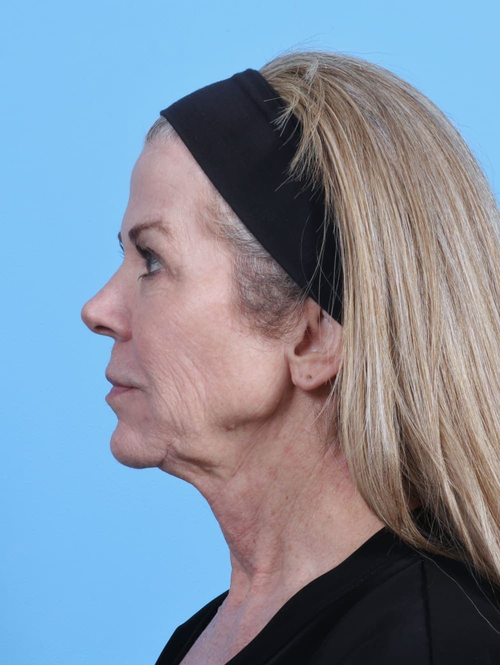 Facelift case #4211 before, image 3