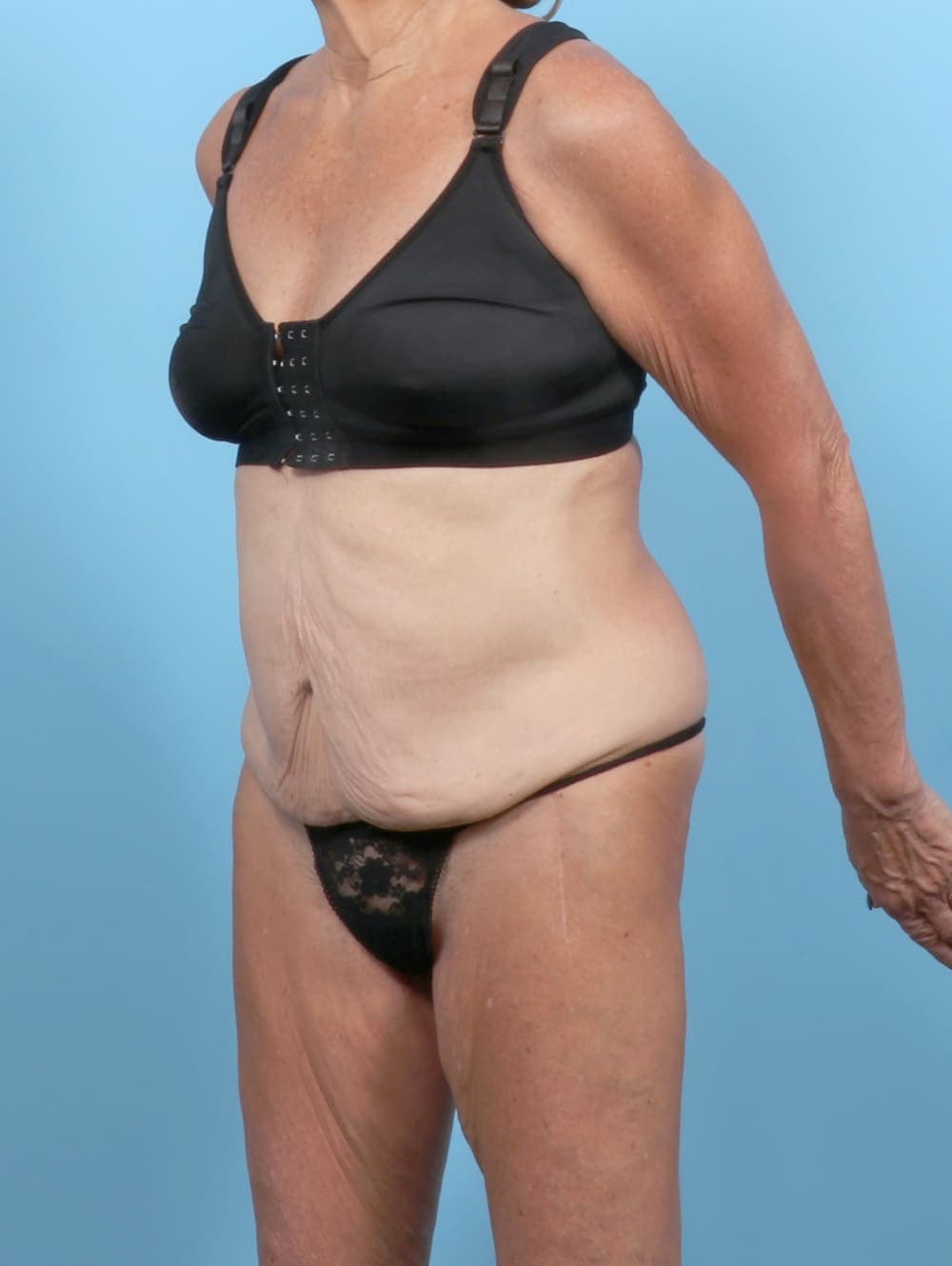 Tummy Tuck case #6189 before, image 2