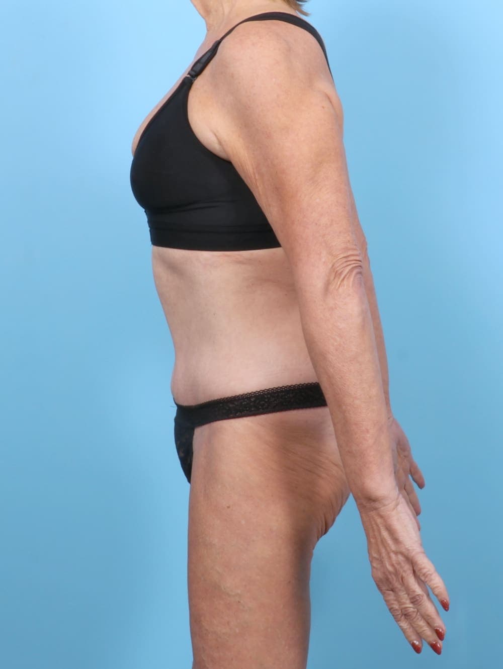 Tummy Tuck case #6189 after, image 3