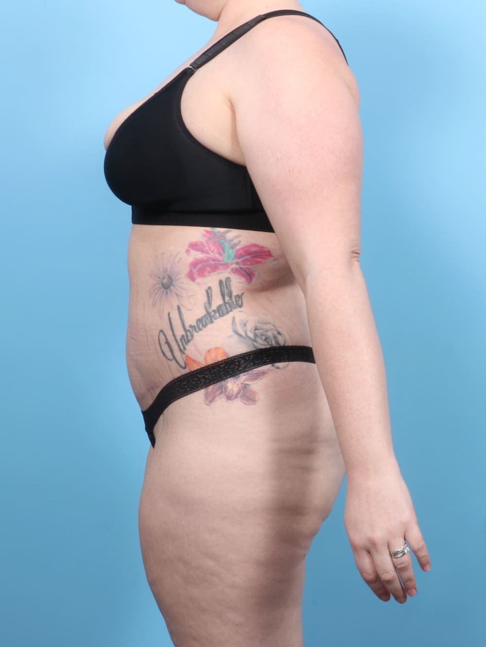 Tummy Tuck case #6565 after, image 3