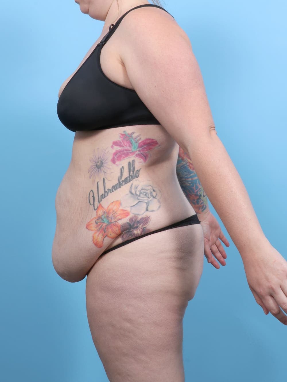 Tummy Tuck case #6565 before, image 3