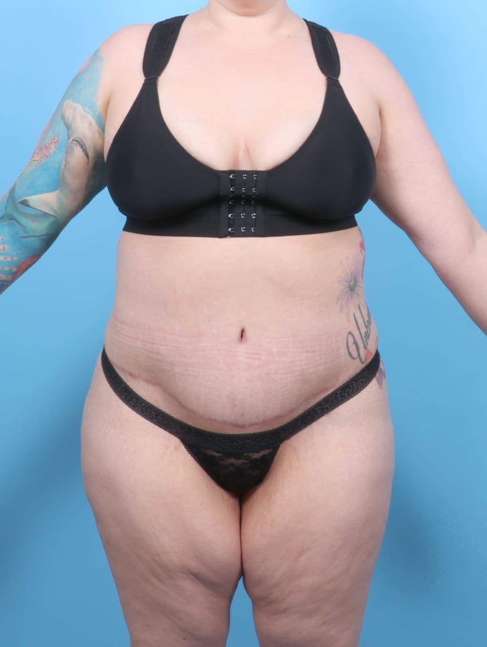Tummy Tuck case #6565 after, image 1