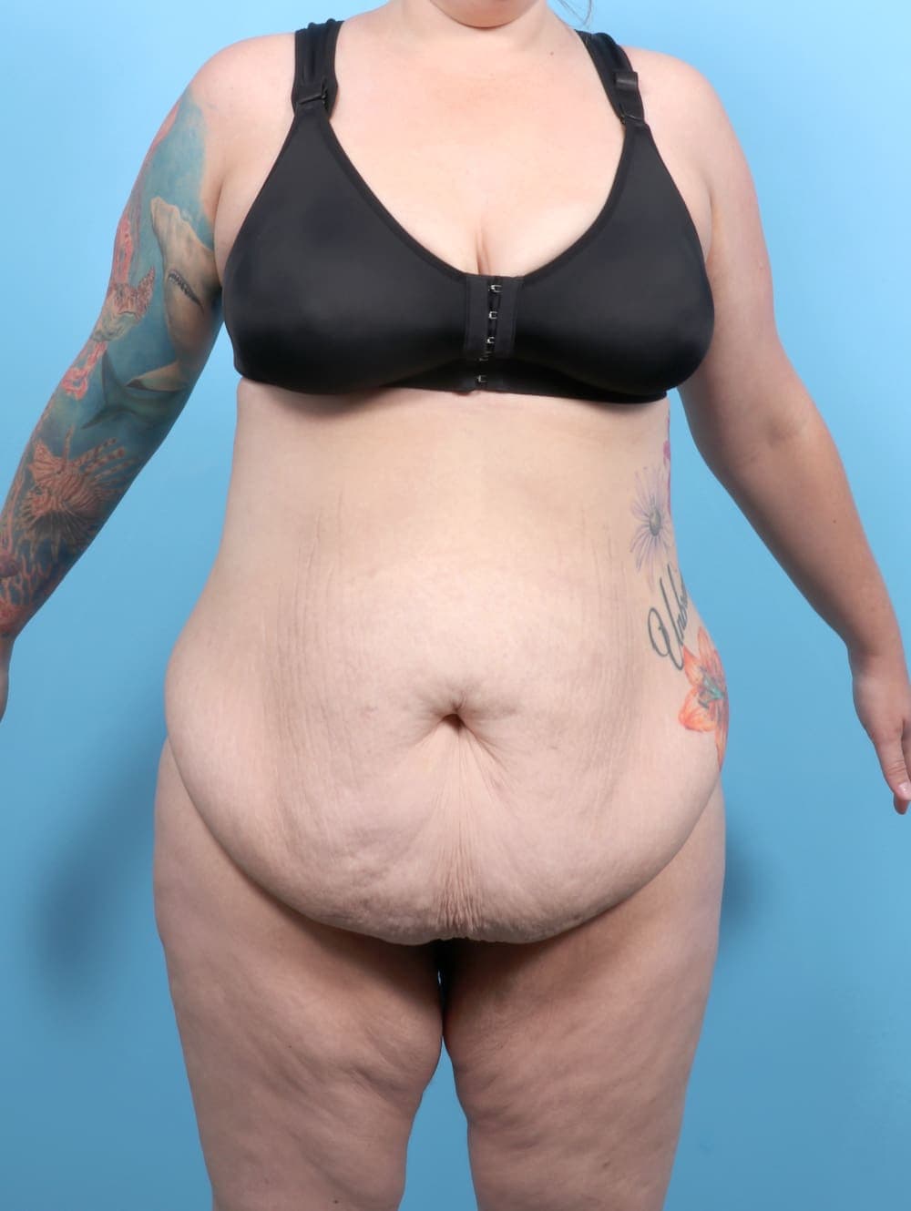 Tummy Tuck case #6565 before, image 1