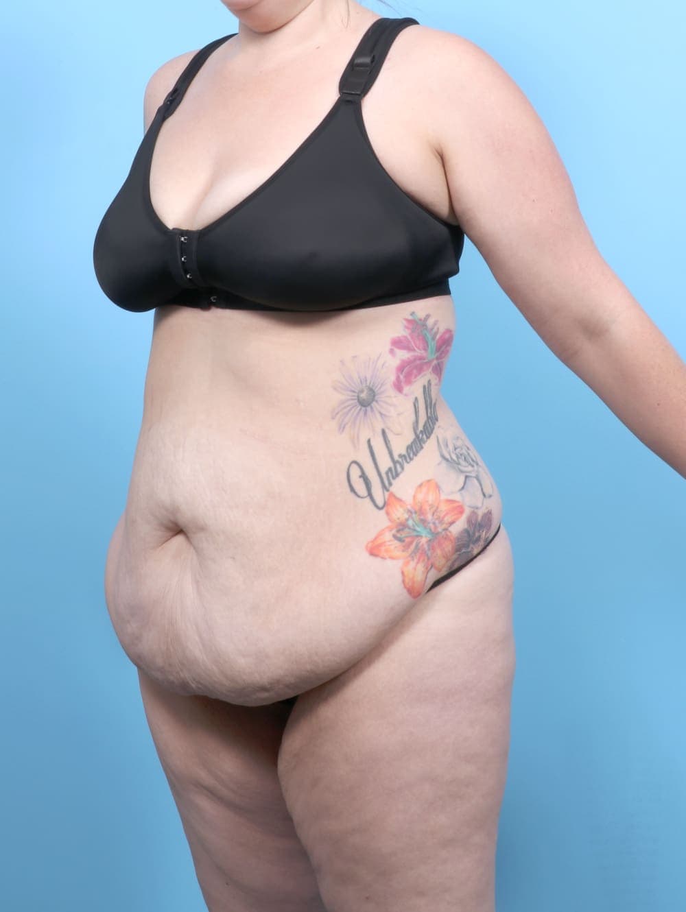 Tummy Tuck case #6565 before, image 2