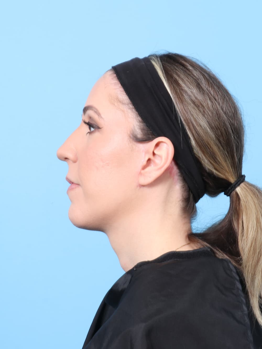 Facelift case #8766 after, image 4