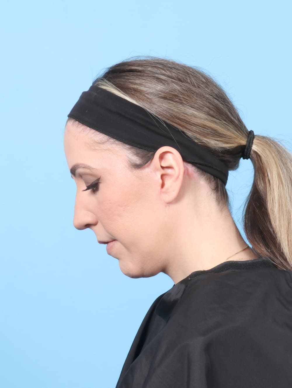Facelift case #8766 after, image 3