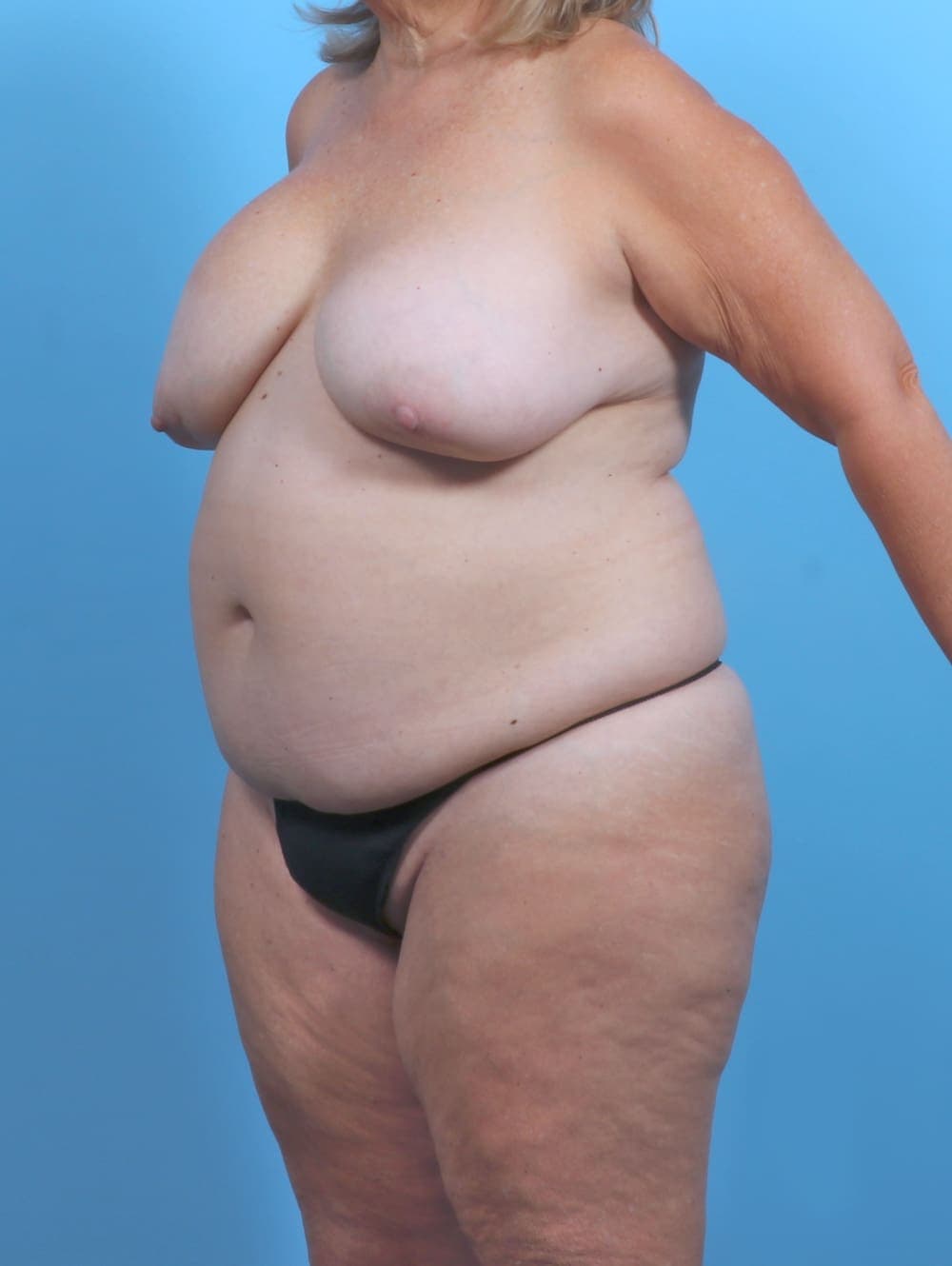 Mommy Makeover case #5265 before, image 3