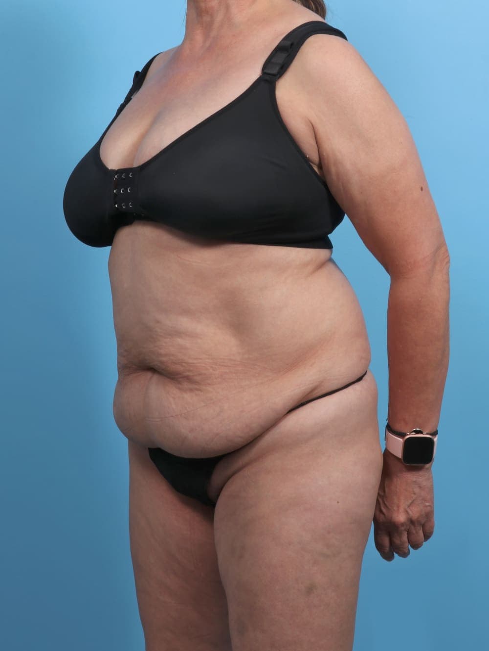 Liposuction case #4489 before, image 3