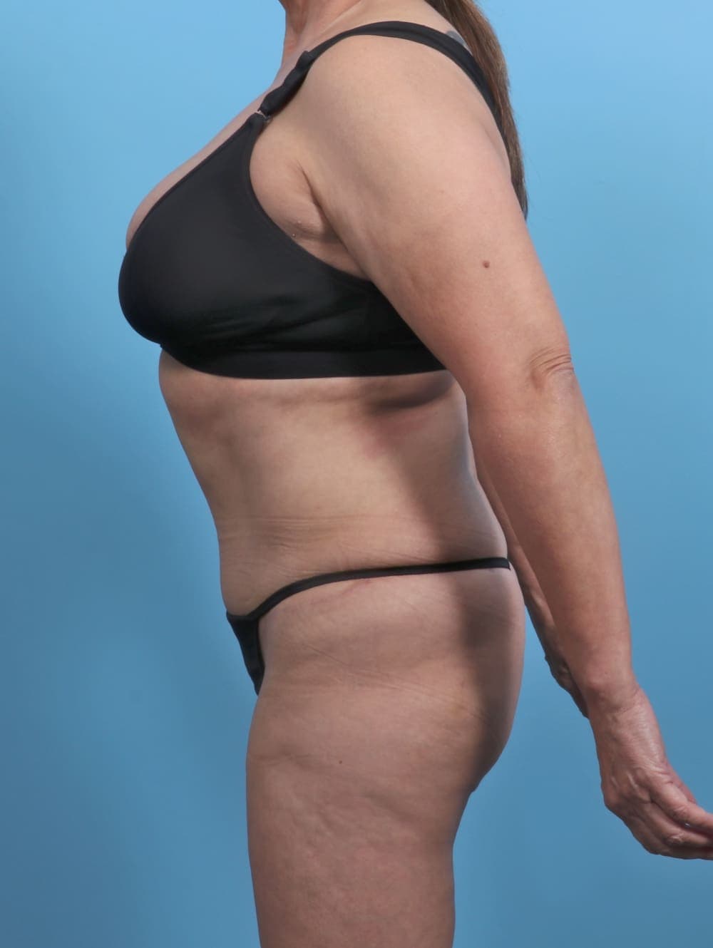 Liposuction case #4489 after, image 4