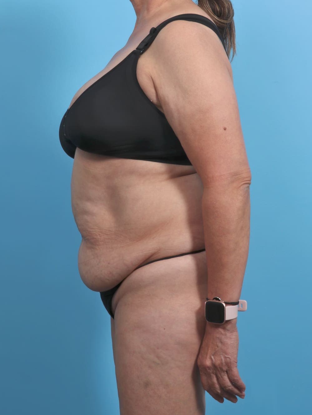 Liposuction case #4489 before, image 4