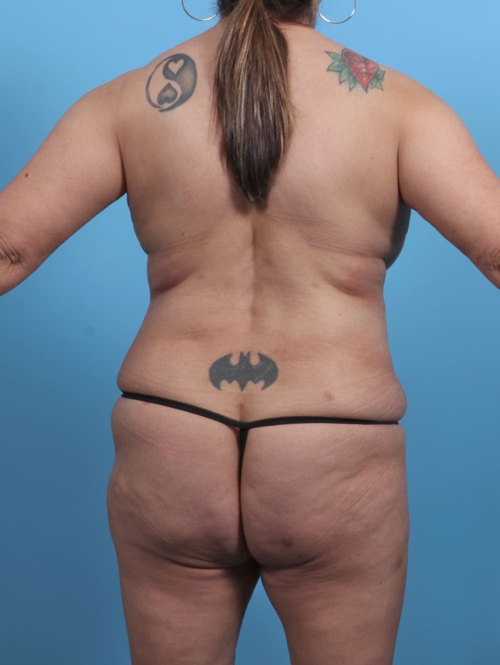 Liposuction case #4489 after, image 2