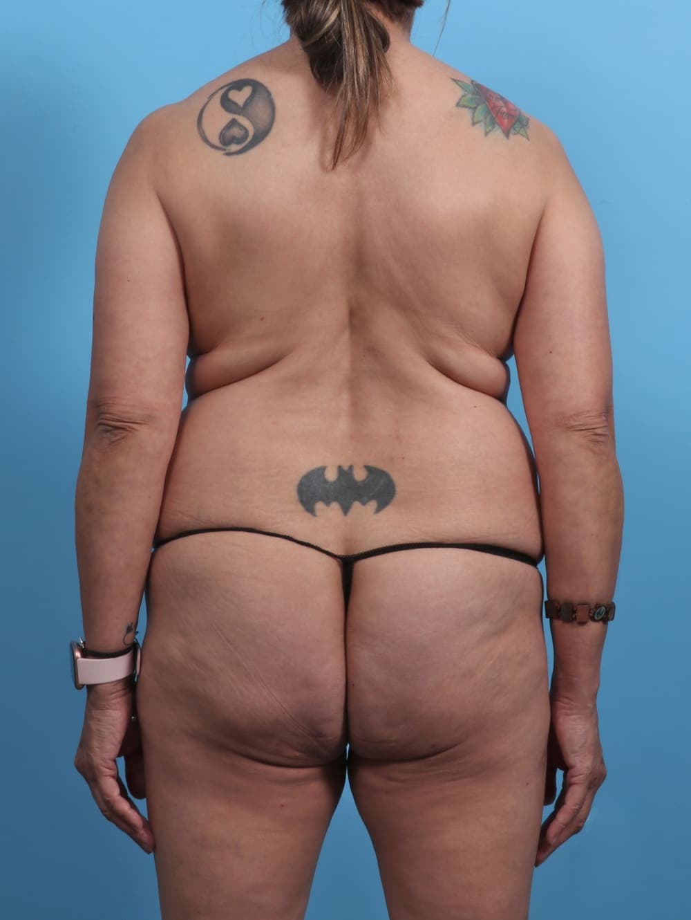 Liposuction case #4489 before, image 2