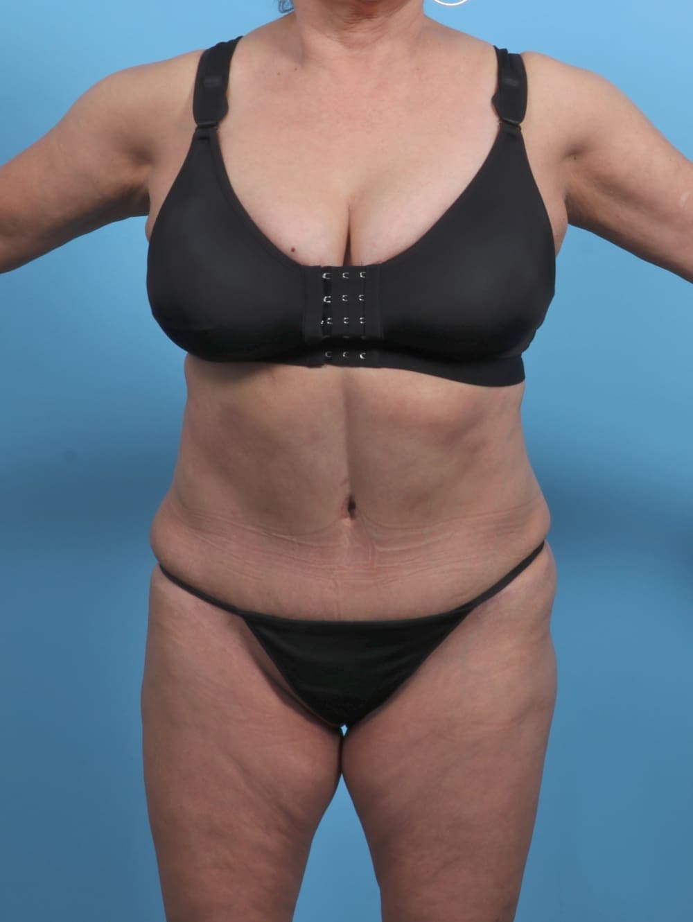 Liposuction case #4489 after, image 1