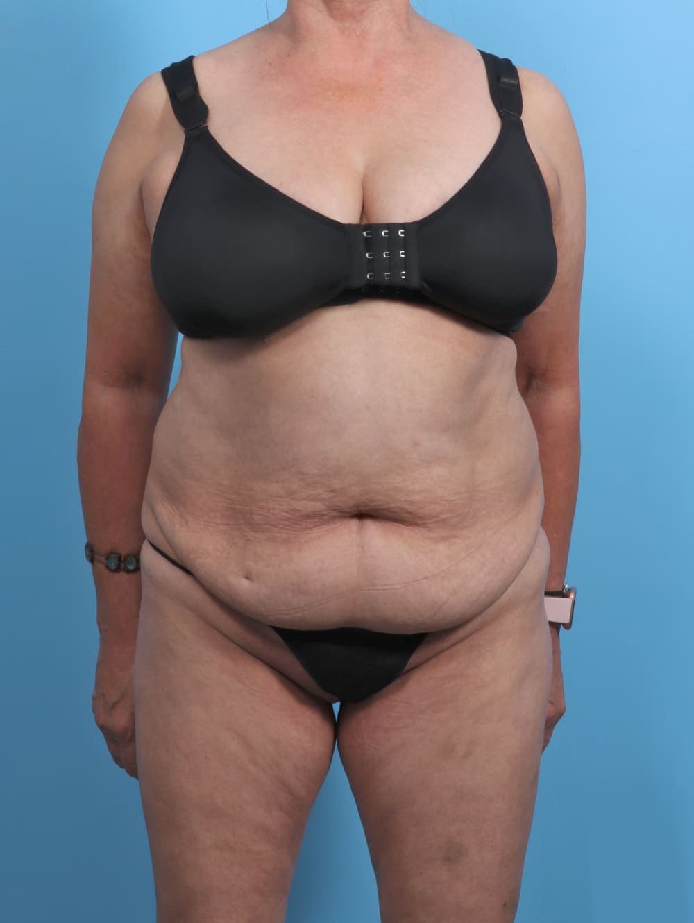 Liposuction case #4489 before, image 1