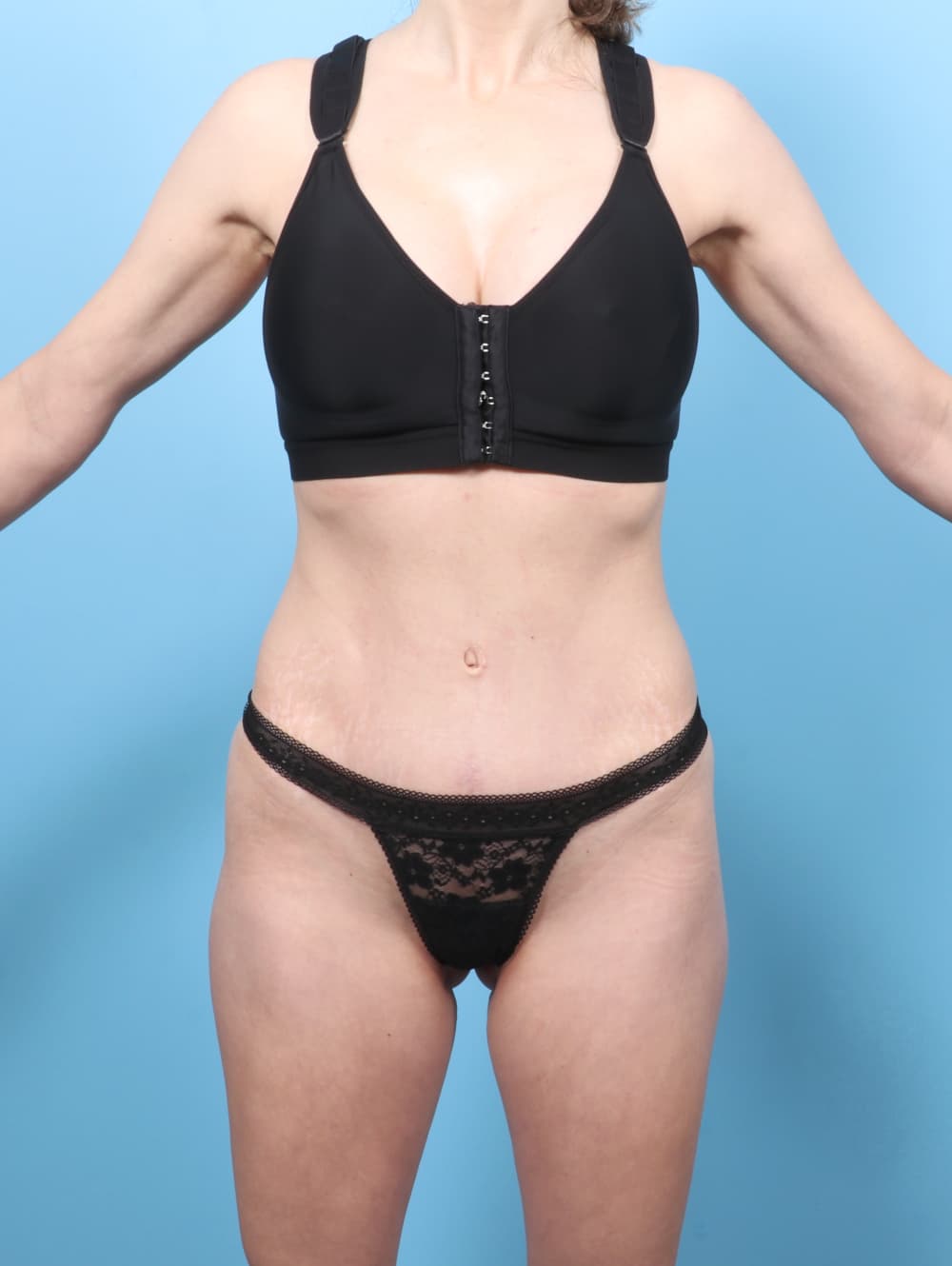 Tummy Tuck case #8650 after