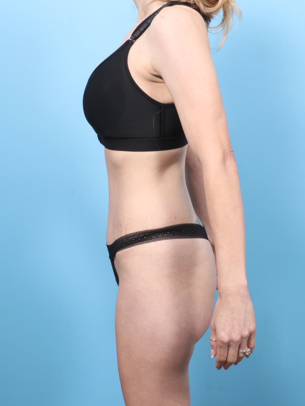Tummy Tuck case #8650 after, image 3