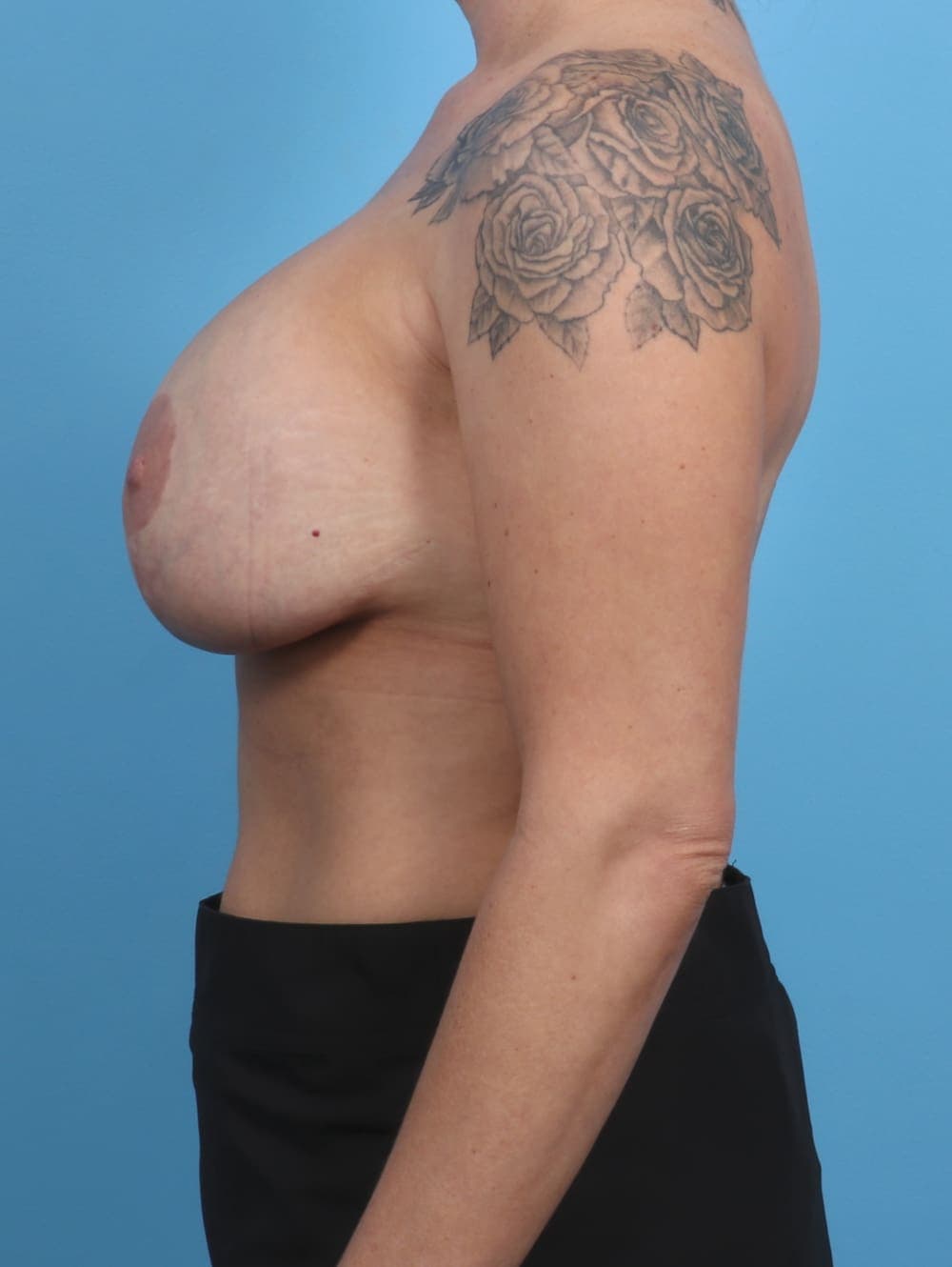 Breast Augmentation case #3967 after, image 3